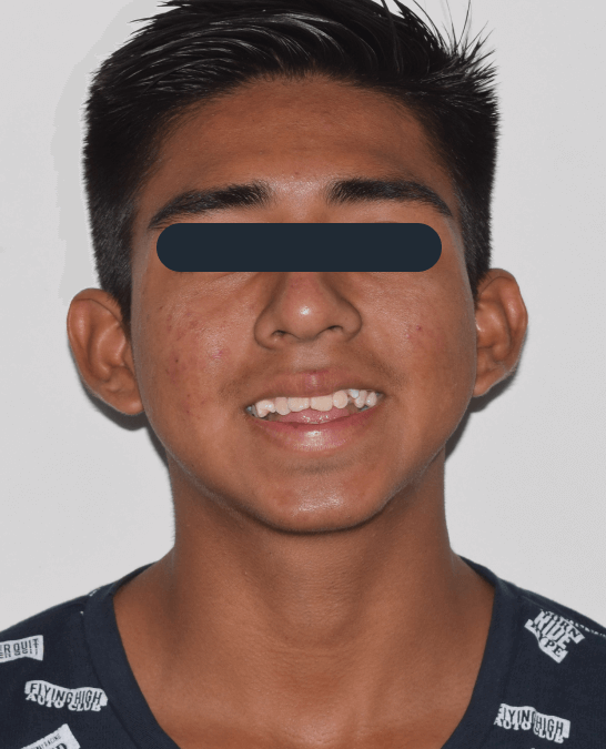 Mordida abierta severa en paciente hombre