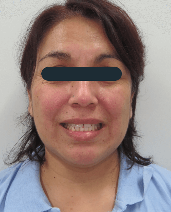 Caso de ortodoncia en mujer adulta